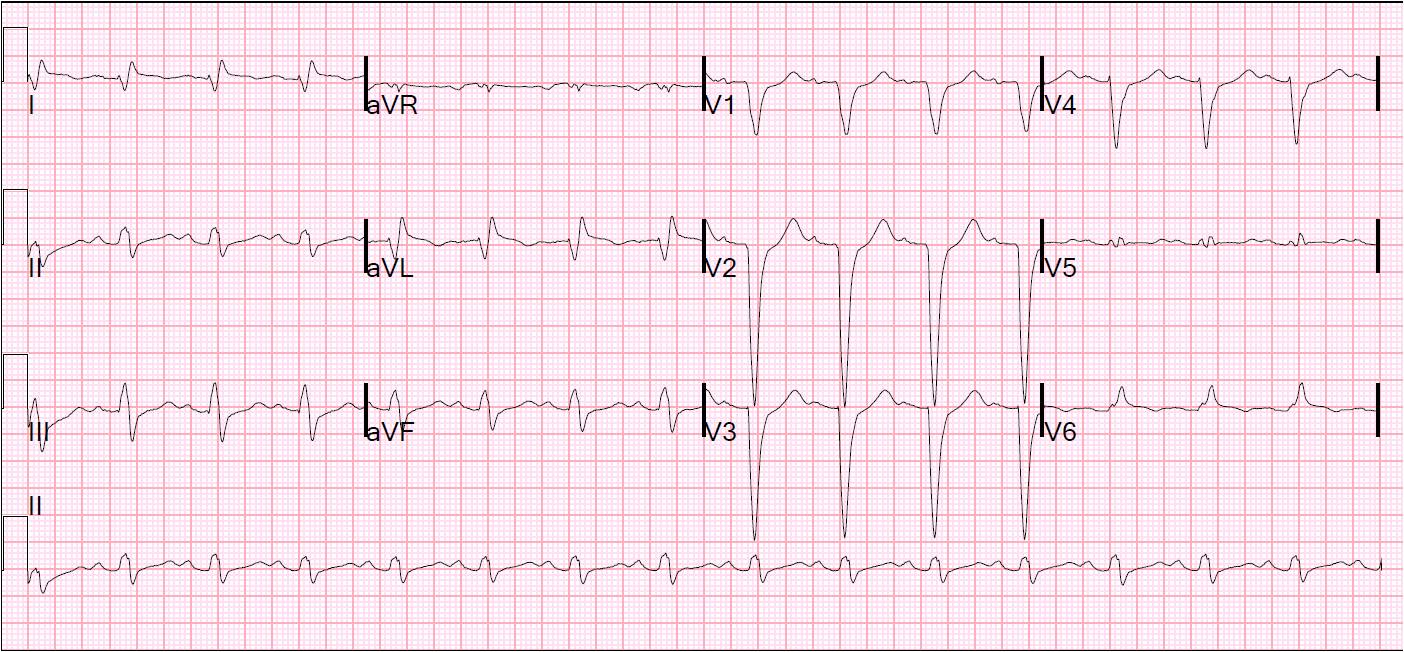 What is the meaning a poor R-wave progression in a cardiogram?